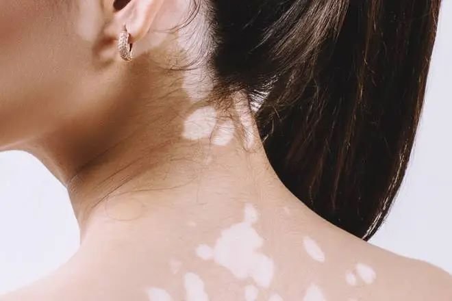 Leucoderma and Vitiligo