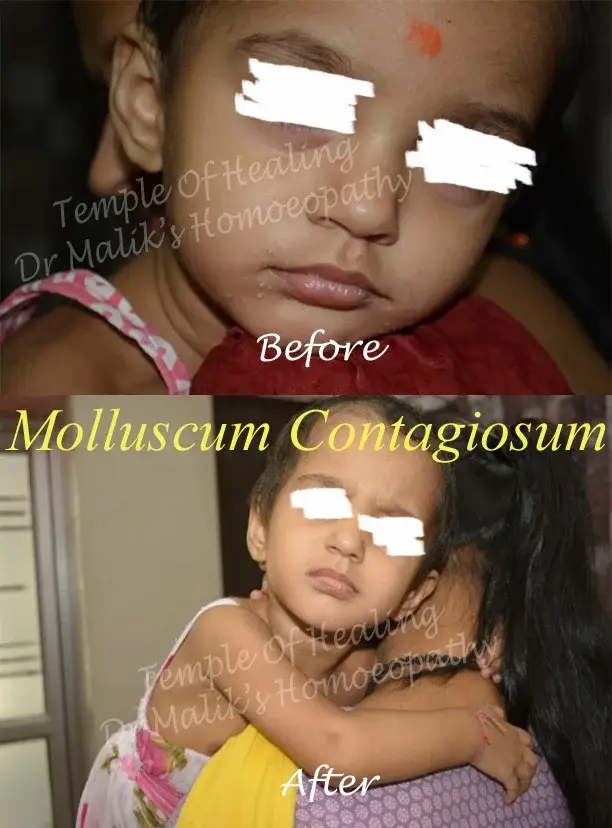 Molluscum-contagiosum1