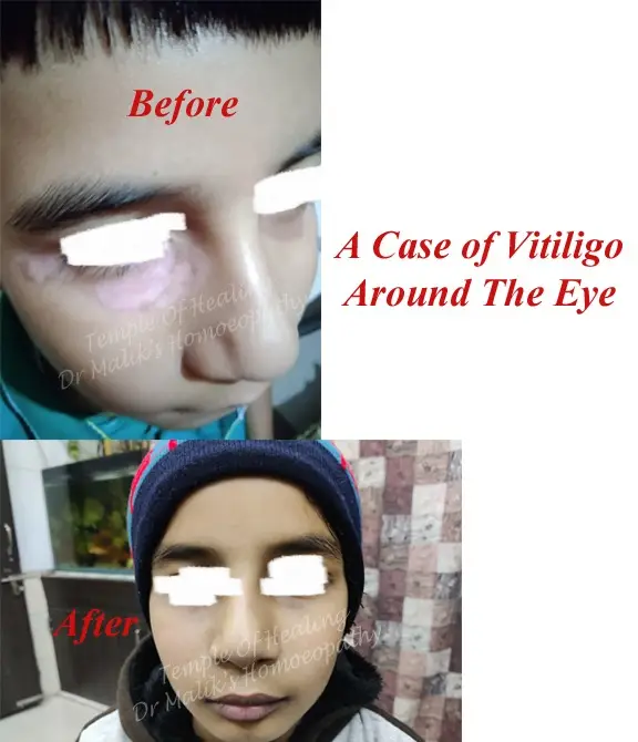 vitiligo1
